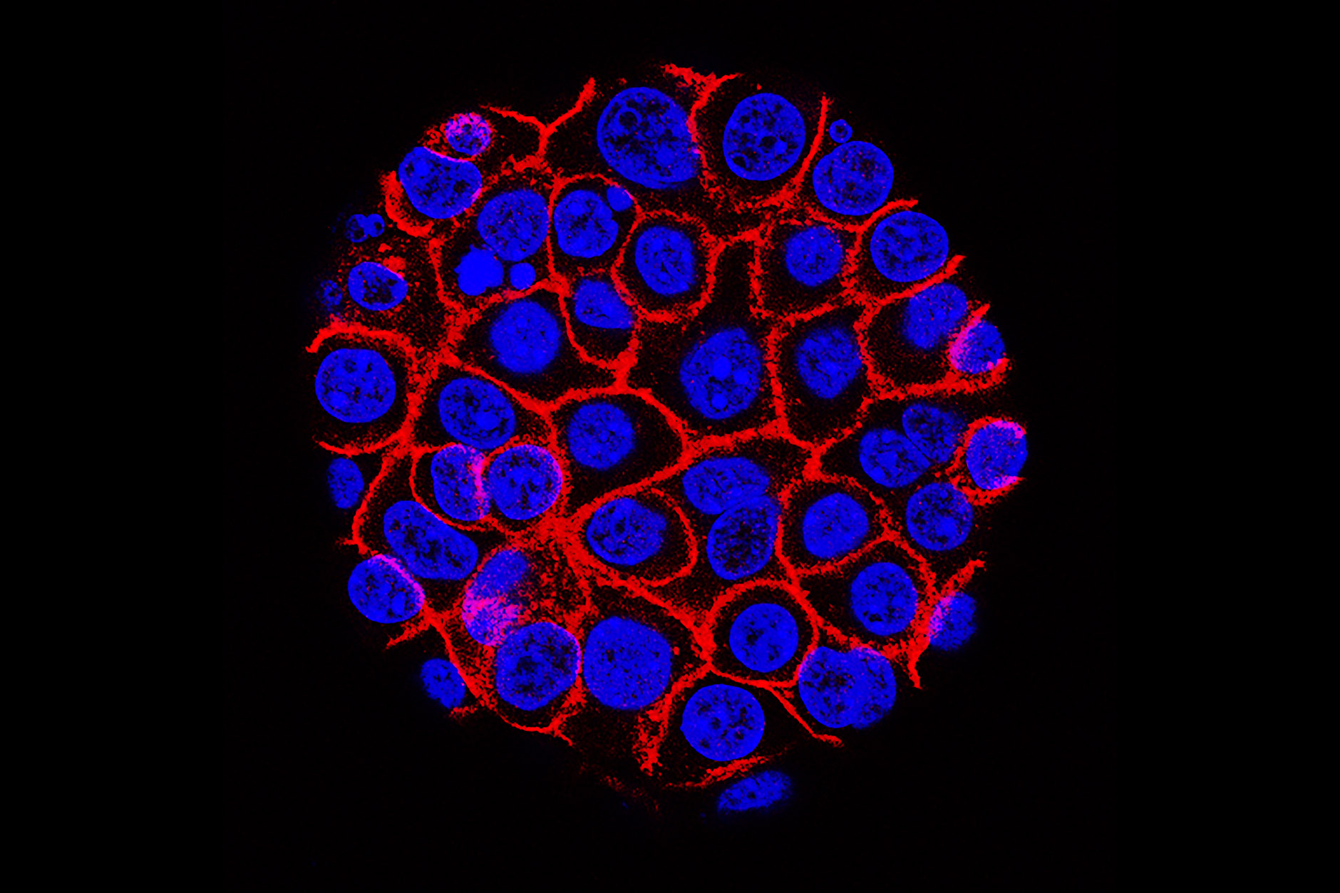 Research Reveals Mechanisms At Work In Progression Of Pancreatic Cysts