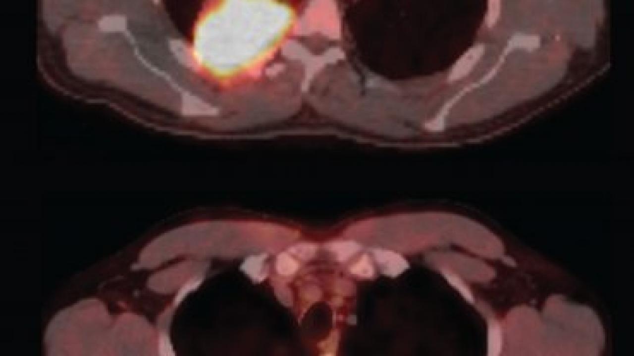 PET-CT imaging from a patient with EGFR-mutant lung cancer before (top) and after (bottom) treatment with the targeted drug erlotinib (Tarceva). By studying the residual tumor seen in the lower image, a UCSF team determined why the patient developed erlotinib resistance, and devised a strategy to overcome it. Image from Blakeley et al., Cell Communications, April 2, 2015.