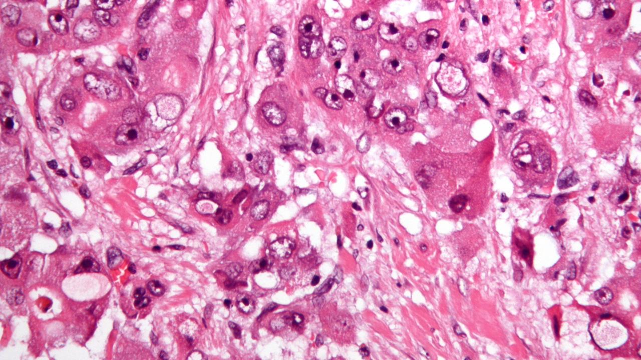 Fibrolamellar hepatocarcinoma.