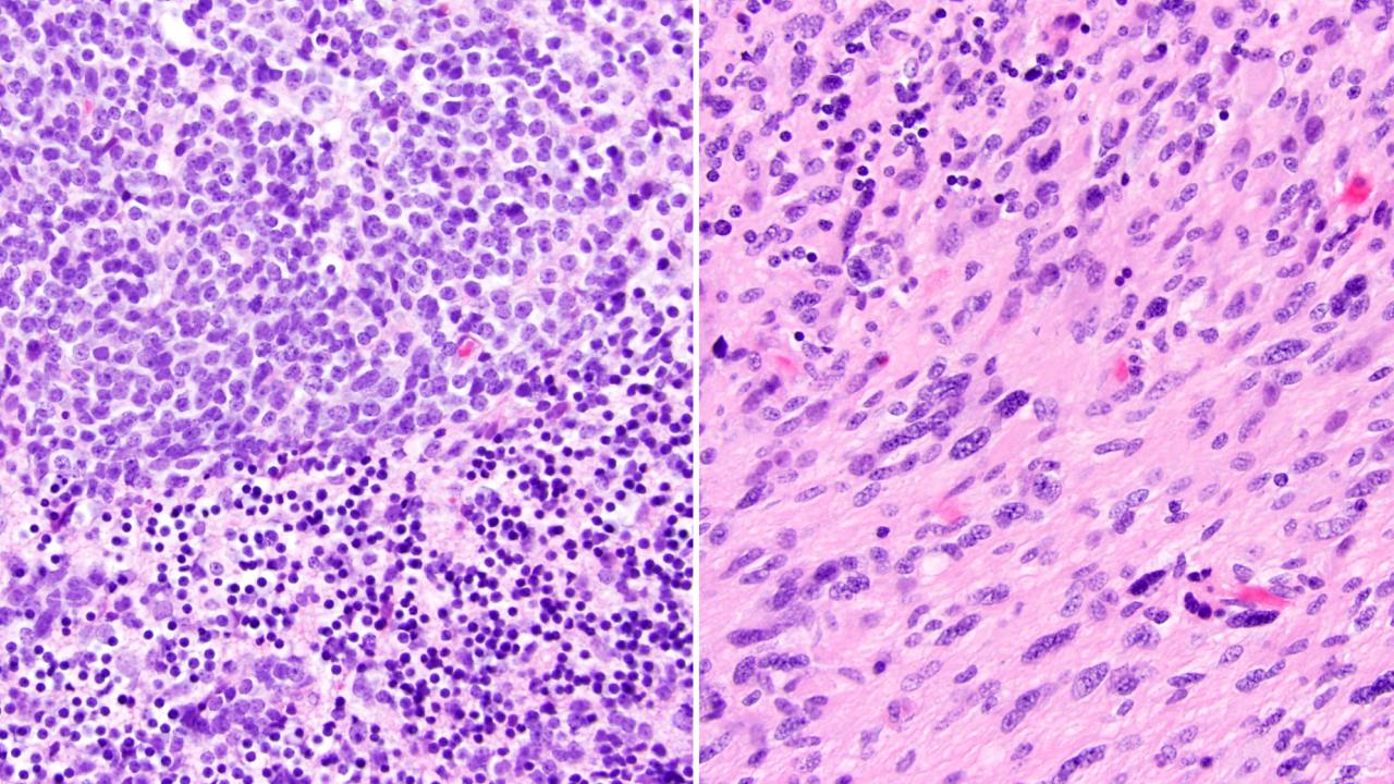 Secondary gliomas can arise following radiation therapy to treat a primary cancer. Pictured here, histology from a patient who was initially treated for medulloblastoma (left) and later developed high-grade glioma (right) following craniospinal radiation.