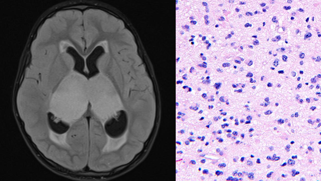 Horizontal MRI (left) and histology (right) of bithalamic glioma in a pediatric patient. Images courtesy of David Solomon.