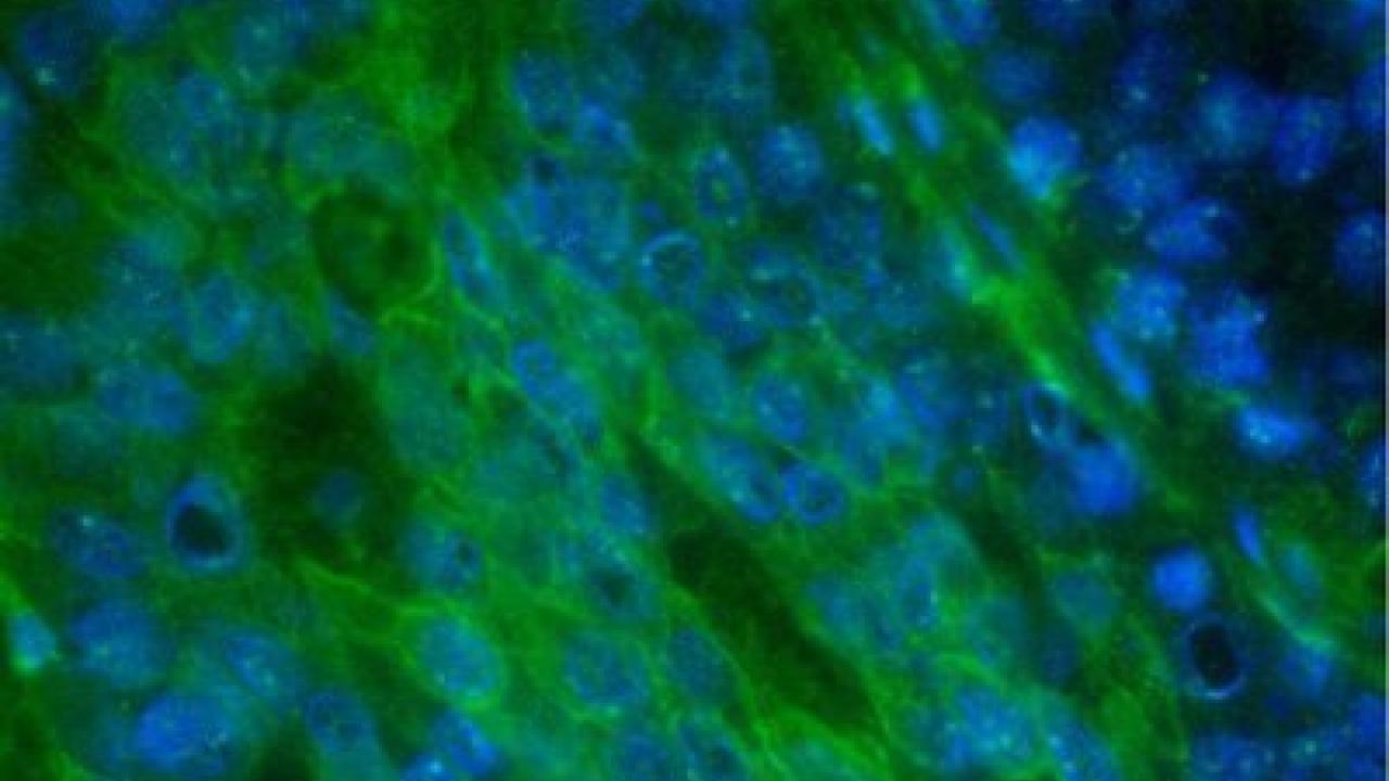 Triple-negative breast cancer tissue shows overproduction of a cell-surface protein called xCT. Image courtesy Luika Timmerman, PhD.