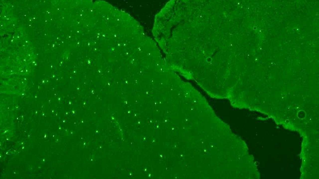 An example of a biospecimen that contains a pattern researchers have dubbed "sparkling" because of how the samplle looks under a microscope. Over time, researchers noticed that the clinical stories of the patients with these samples were the same: they had ataxia and testicular cancer.