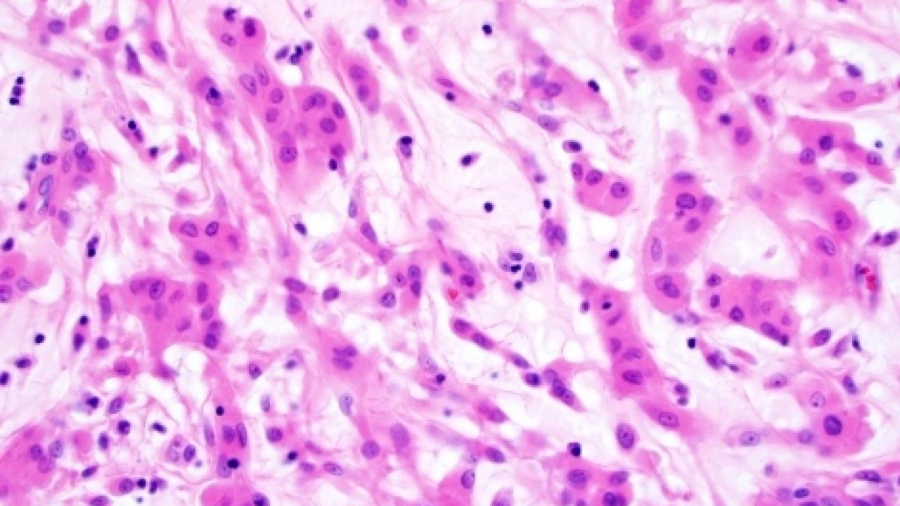 A microscopic image of chordoid glioma.