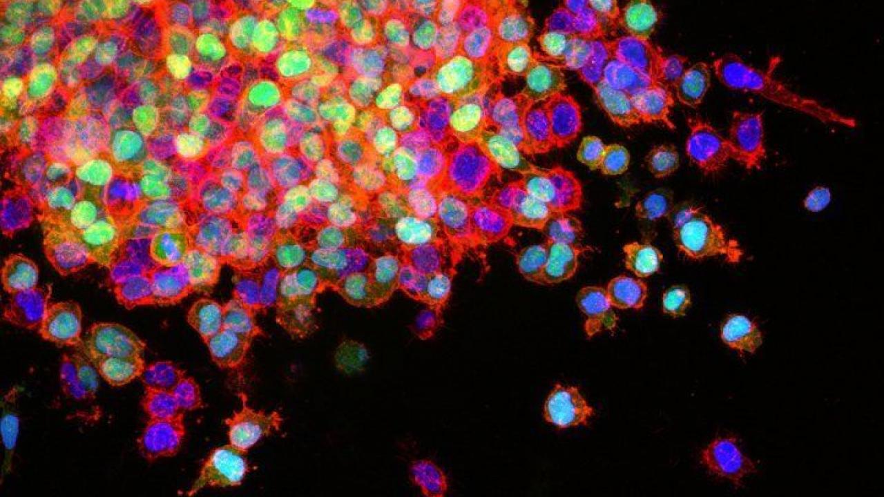 Lung cancer cells invade surrounding tissues and start to spread. Image courtesy of the National Cancer Institute