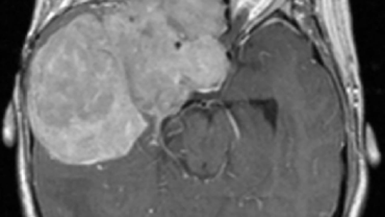 Meningioma scan Credit Raleigh lab / UCSF