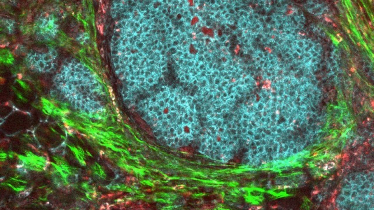 breast cancer tumor and its microenvironment/ photo: NCI