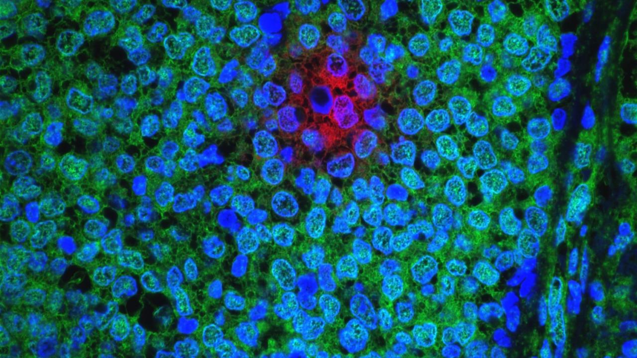 Treatment-Resistant Breast Cancer Cells. Image by Sheheryar Kabraji, Sridhar Ramaswamy. Courtesy of the 2016 NCI Cancer Close Up Collection.