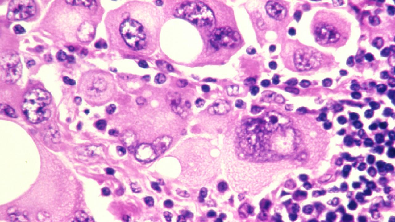 Human metastatic melanoma cells, courtesy of the Web site of the National Cancer Institute (http://www.cancer.gov).