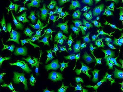 Image of neuroblastoma cells, the most common solid cancer found in children younger than age 5. Credit: The Cell Image Library / CC BY 3.0