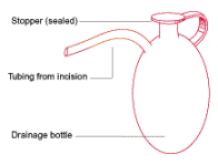 About JP Drains for Your Surgery