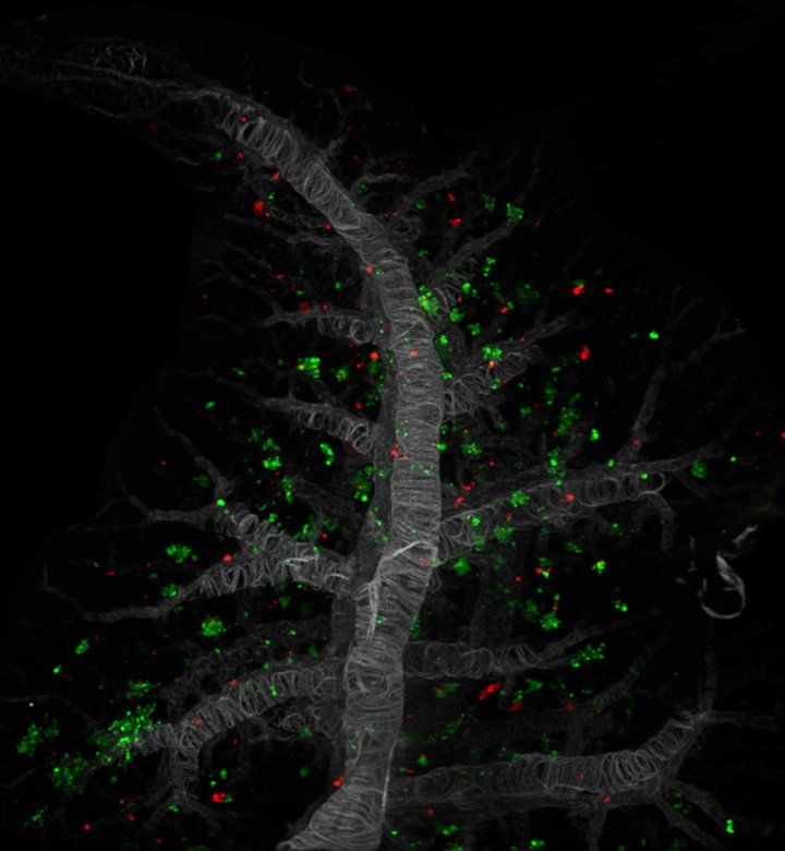 Pancreatic Cancer Spreads to Liver or Lung Thanks to This Protein