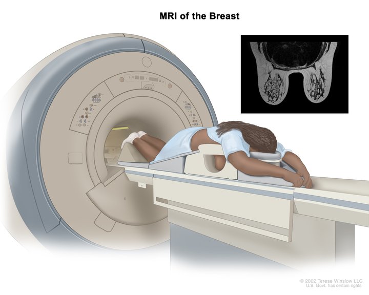 Inclusion Of New Risk Factors Improves Prediction Of Invasive Breast ...