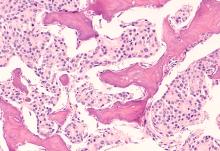 Photomicrograph of bone biopsy showing metastasis of prostatic adenocarcinoma within the marrow space.