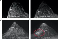 Changes in ipsilateral breast MRI features, Fig. 5, DOI:10.1038/s41523-024-00677-9