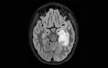 Low Grade Glioma