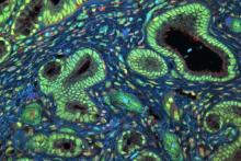 The growth protein, MYC, was consistently found with RBM42, which spurs MYC production, in human pancreatic tumors. Above, microscopy for MYC (red) and RBM42 (green) in a representative pancreatic tumor biopsy from a patient. Image by Kovalski et al., Nature Cell Biology.