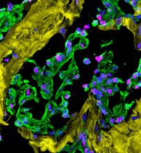 Fluorescent microscopy image of a fibrotic breast tumor, with DNA damage highlighted in pink