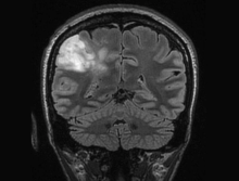X-ray of head showing glioma 