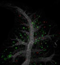 Microscopic image showing metastatic pancreatic cancer cells in a lung.
