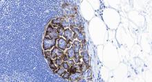 micropapillary bladder cancer