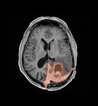 Brain scan showing a meningioma highlighted in orange. Photo by UCSF Brain Tumor Center