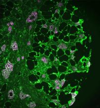 A microscopic image of breast tissue showing molecular tunnels briding tumor cells with nearby fat cells.
