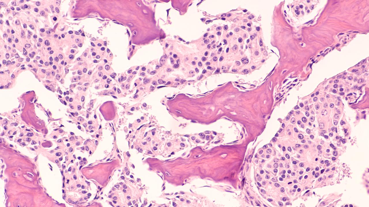 Metastatic prostate cancer: photomicrograph of bone biopsy showing metastasis of prostatic adenocarcinoma within the marrow space. Photomicrograph of bone biopsy showing metastasis of prostatic adenocarcinoma within the marrow space.