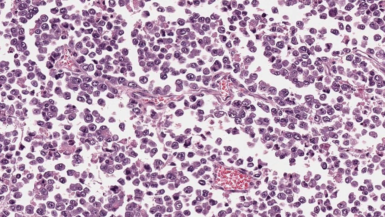 Childhood Cancer Hijacks Cellular Quality Control System to Fuel Growth