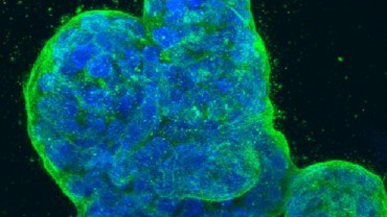A three-dimensional culture of human breast cancer cells. Source: National Cancer Institute