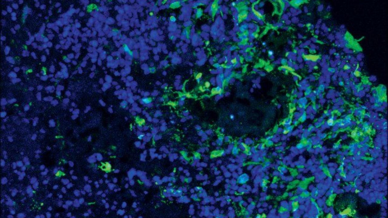 Microscopy of glioblastoma cells invading a brain organoid, with glioblastoma cells in green and brain organoid cells in blue Microscopy of glioblastoma cells invading a brain organoid, with glioblastoma cells in green and brain organoid cells in blue