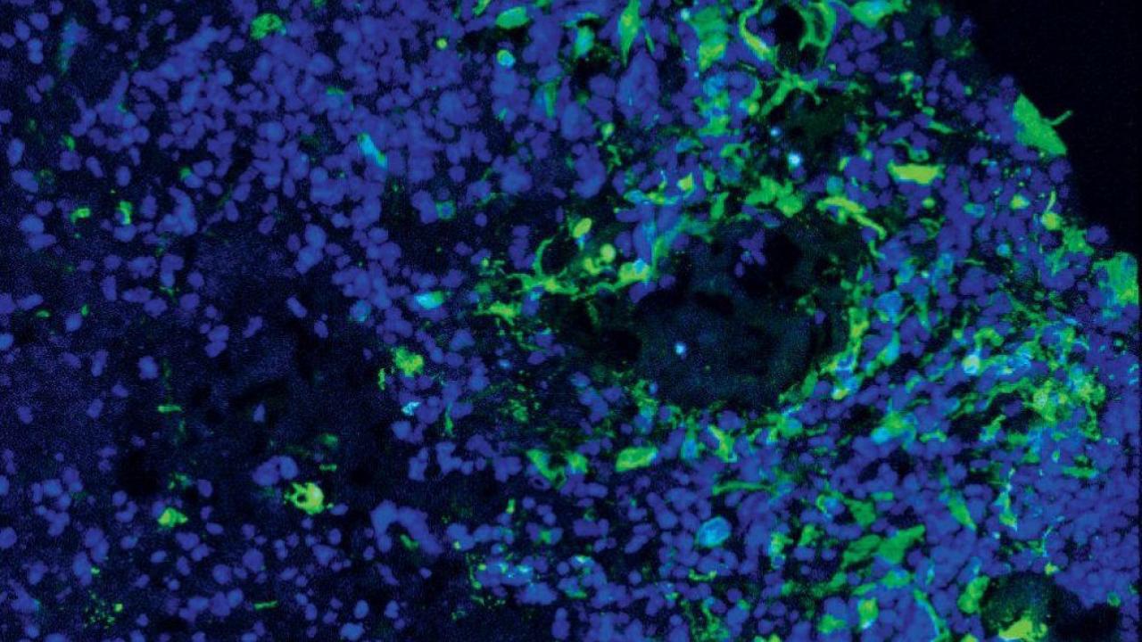 Glioblastoma cells (green) invade a brain organoid grown from human stem cells (blue).