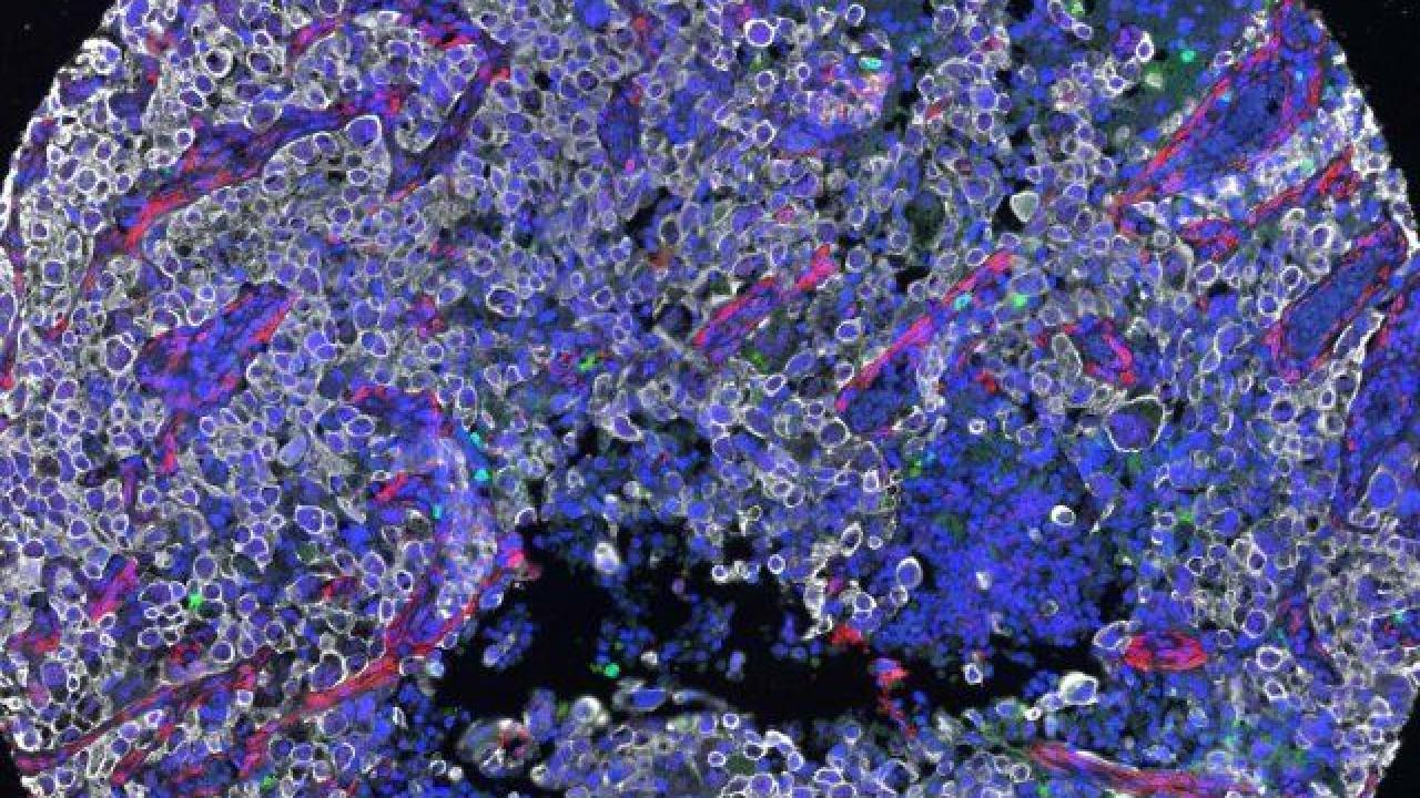 Microscopy of a lung tumor biopsy by Lin Ma
