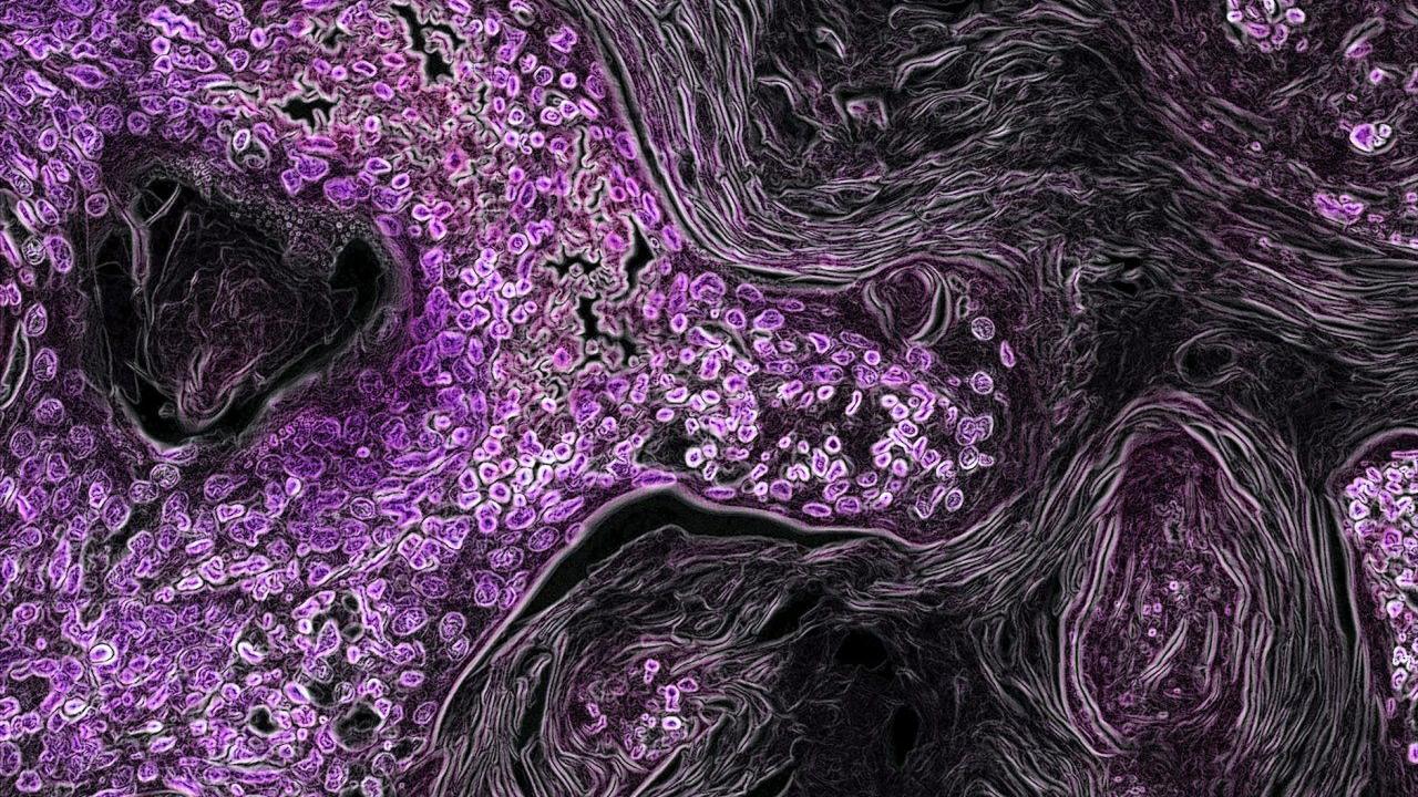 In this image from a genetically engineered mouse model, lung cancer driven by the Kras oncogene shows up in purple. As a key driver in many types of cancer, the Kras gene makes a promising target for new cancer therapies. Image by National Institutes of Health KRAS Kevan Shokat