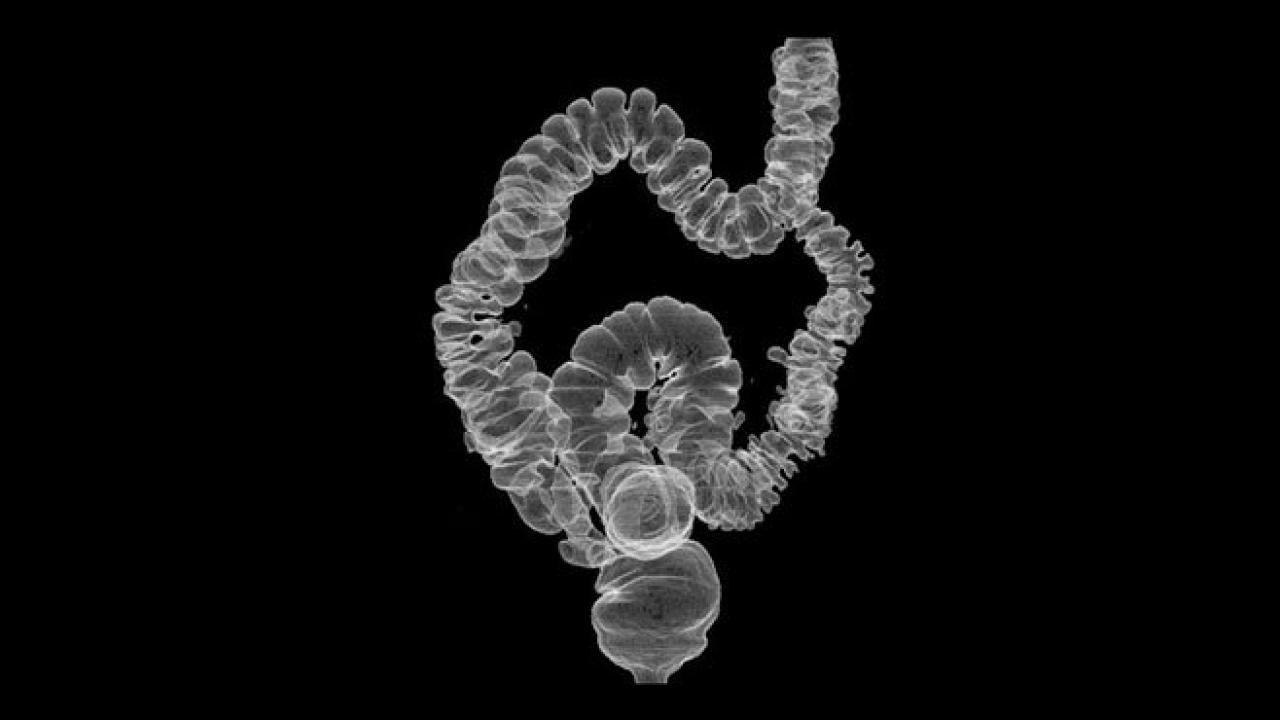 New Colorectal Cancer Screening Guidelines from the ACS What You