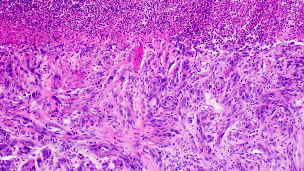 "Skin Tumors-045" by LWozniak&KWZielinski - Own work. Licensed under CC BY-SA 3.0 via Commons.