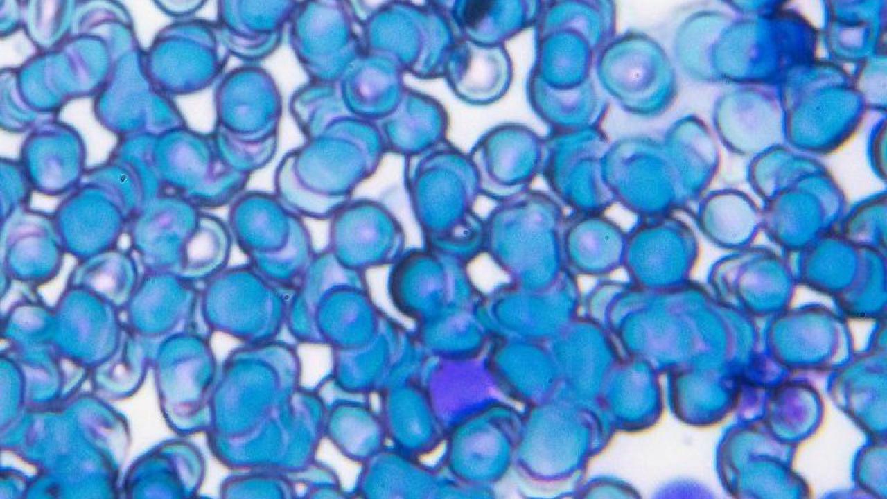 Acute Lymphoblastic Leukemia