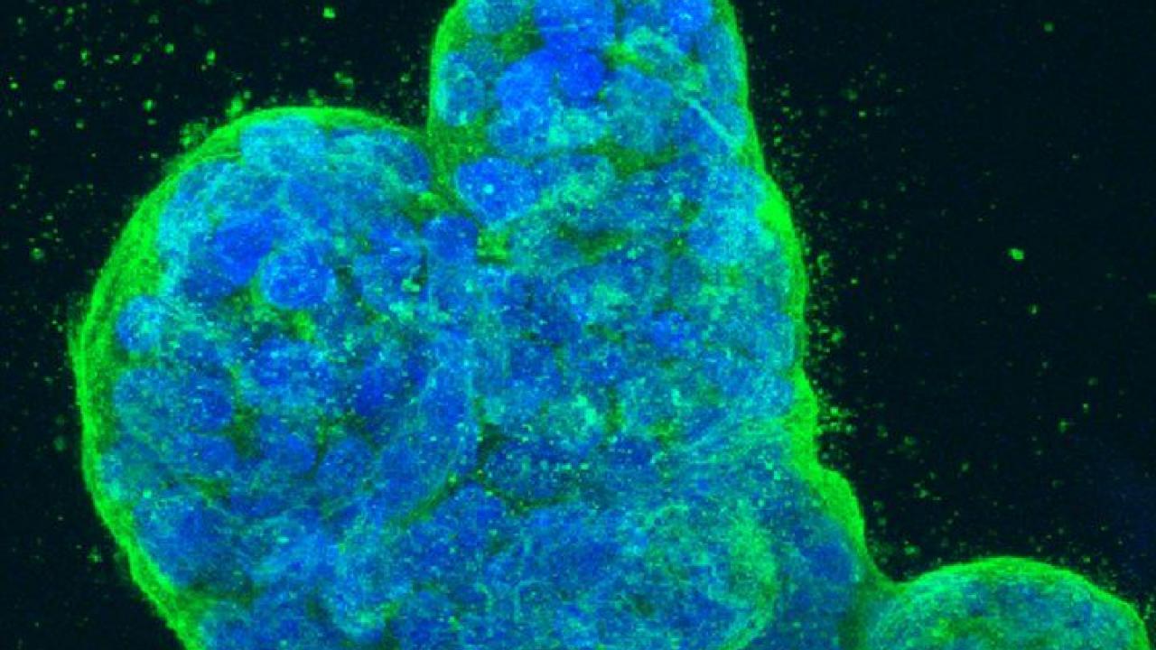 Breast Cancer Cells