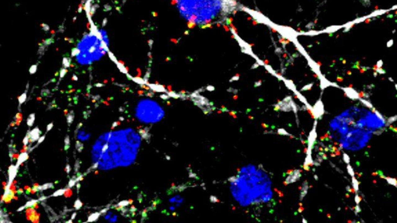 Human glioblastoma cells showing areas where new connections between cells are being formed at an accelerated rate. Image by Hervey-Jumper Human glioblastoma cells showing areas where new connections between cells are being formed at an accelerated rate. Image by Hervey-Jumper