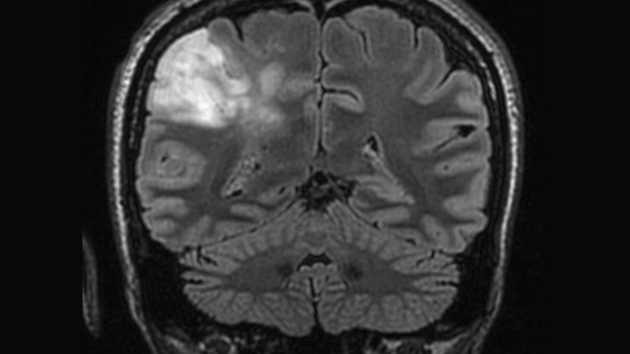 X-ray of head showing glioma
