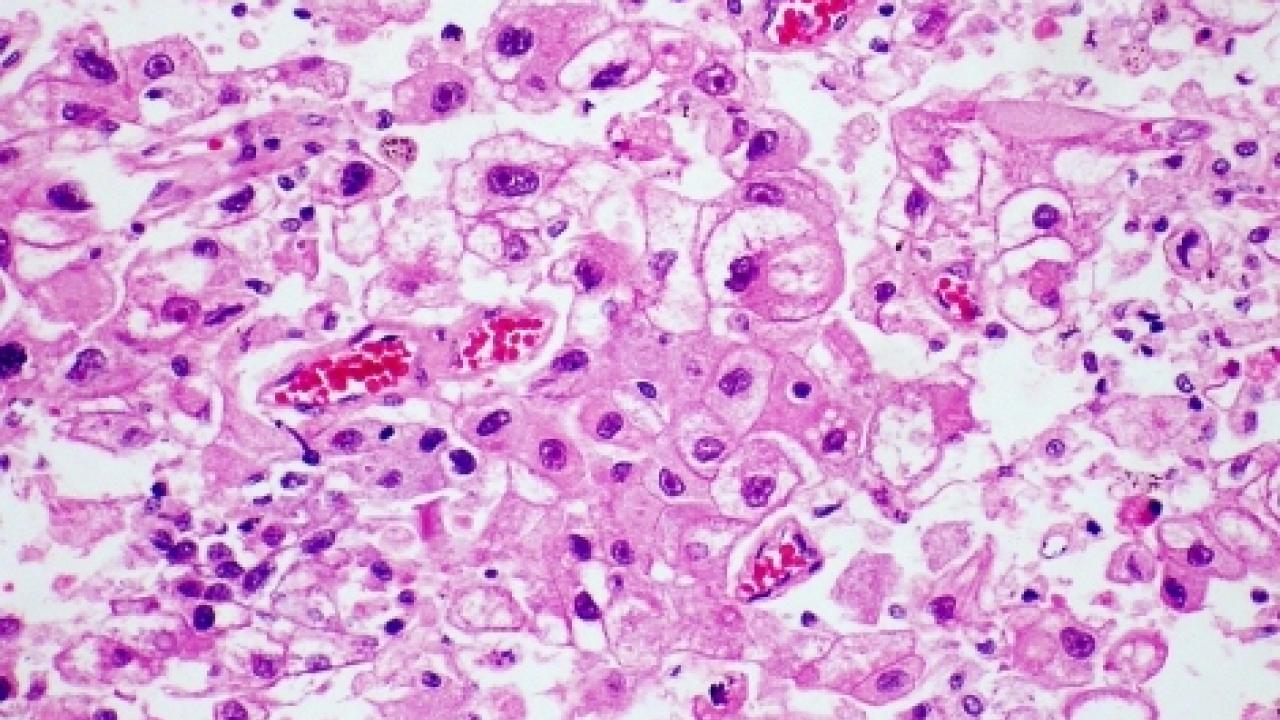 Metastatic hepatocellular carcinoma. Image by Yale Rosen via Flickr