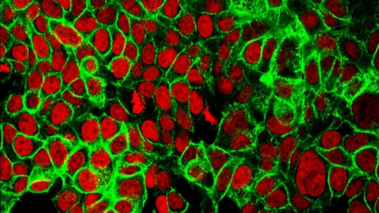 Colon cancer cells. Image courtesy the NCI Center for Cancer Research.