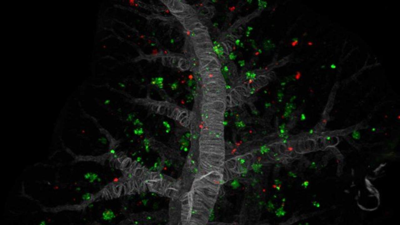 Microscopic image showing metastatic pancreatic cancer cells in a lung.