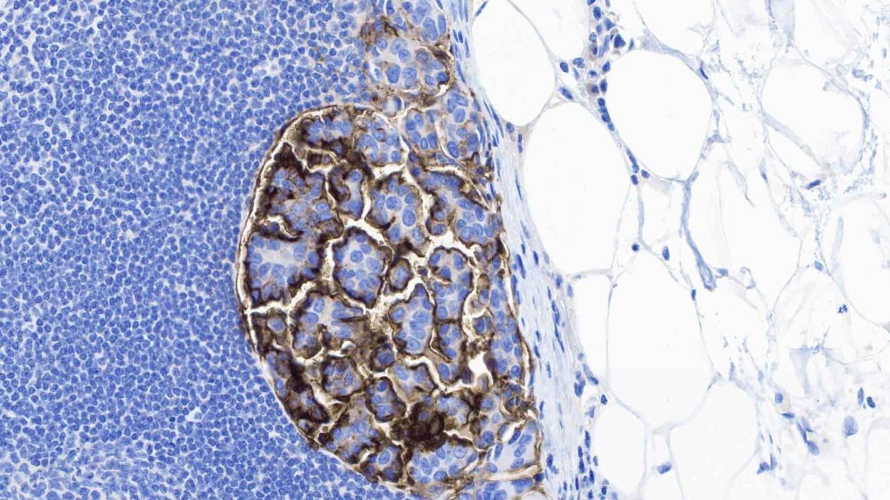 micropapillary bladder cancer