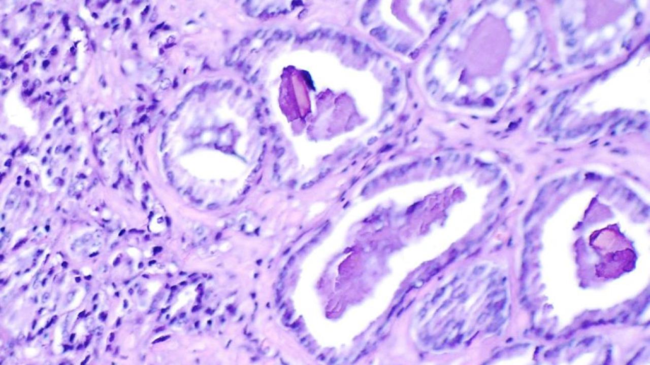 Prostate Cancer cells, courtesy the NCI