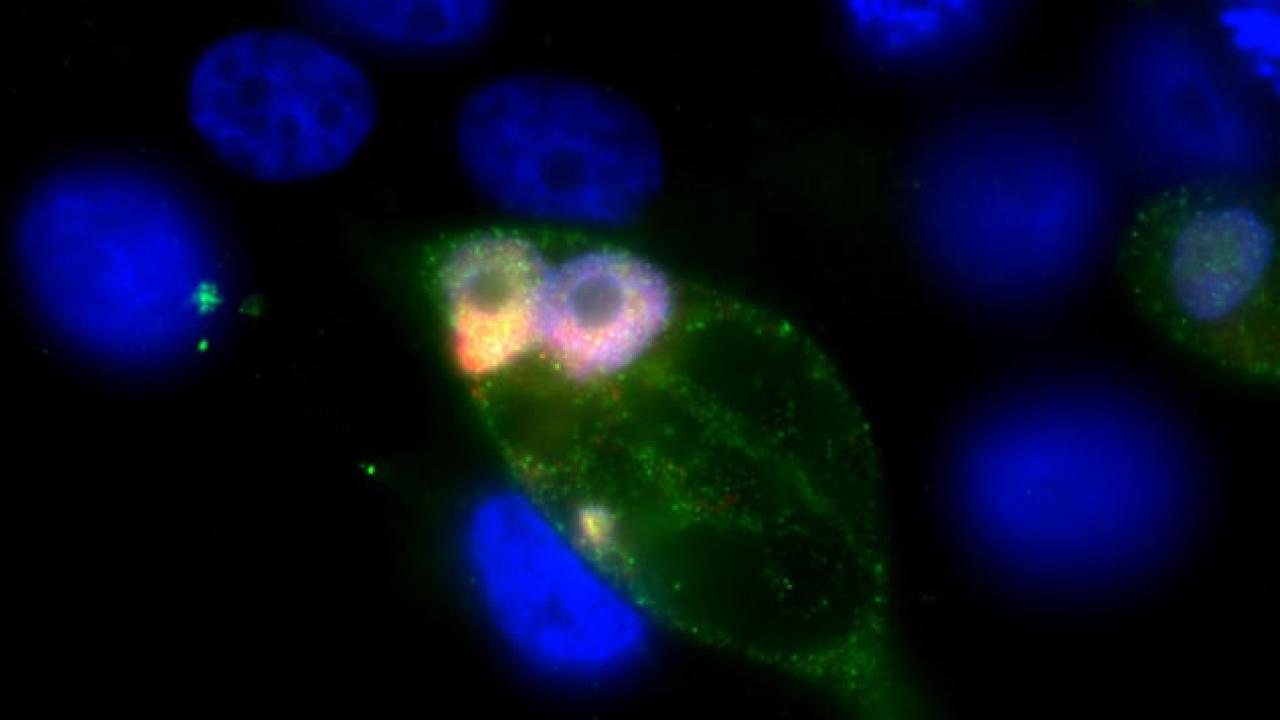 TGF-beta Signaling in Human Breast Cancer Cells. Image courtesy of NCI Center for Cancer Research TGF-beta Signaling in Human Breast Cancer Cells