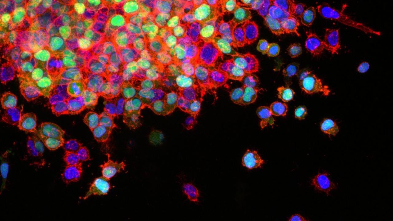 Lung Cancer Metastasis. Image by Scott Wilkinson, Adam Marcus. Courtesy of the 2016 NCI Cancer Close Up Collection. Lung Cancer Metastasis. Image by Scott Wilkinson, Adam Marcus. Courtesy of the 2016 NCI Cancer Close Up Collection.