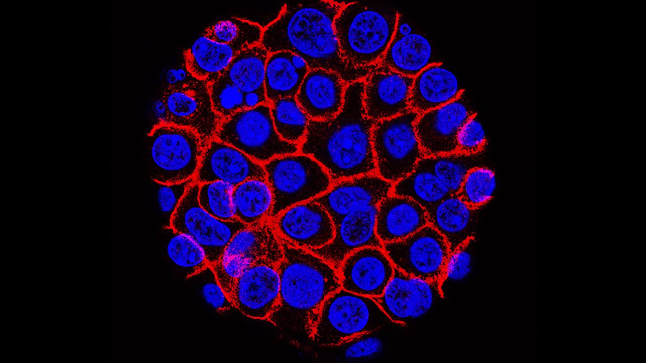 An international, UCSF-led research team reveal has outlined the comprehensive immune landscape and microbiome of pancreatic cysts as they progress from benign cysts to pancreatic cancer. Pictured above are pancreatic cancer cells (nuclei in blue) growing as a sphere encased in membranes (red). Image by Min Yu, USC Norris Comprehensive Cancer Center, Pancreatic Desmoplasia microscopic image of pancreatic cancer cells