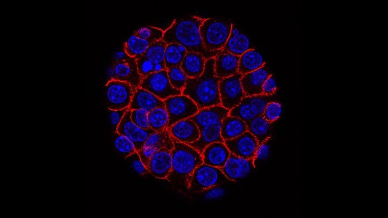 Pancreatic cancer cells. pancreatic cancer cells