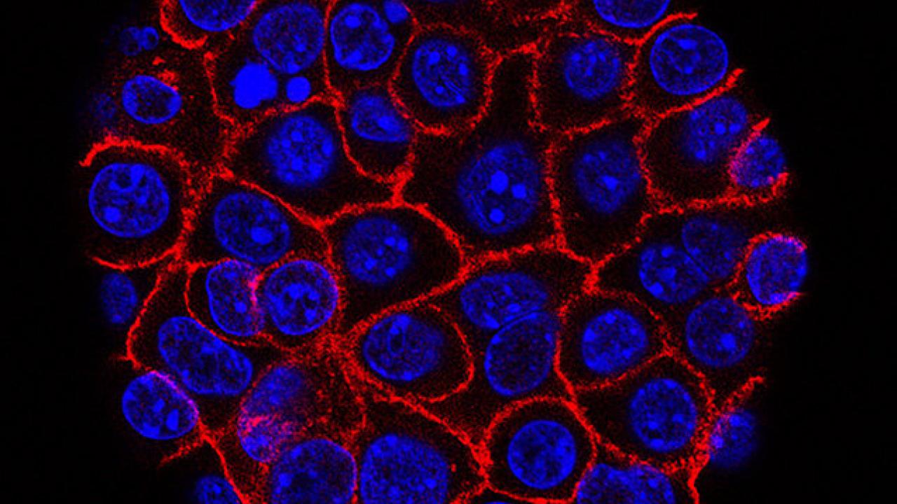 Pancreatic cancer cells. Image courtesy of NIH Images